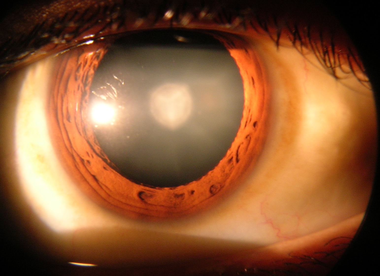 Почему происходит катаракта глаза?